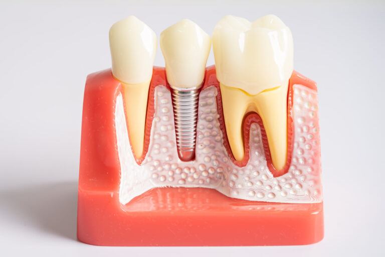 Dental Implants in Antalya